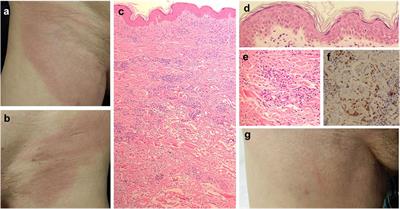 Case report: Reactive granulomatous dermatitis presenting with inguinal erythematous plaques in a patient administered with pravastatin